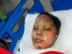 Lady Bathed In Acid For Refusing Muslim Mans Marriage Proposal